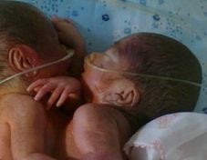 Bayi kembar siam dempet...