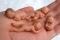 Aborsi, Yeni alami pendarahan...