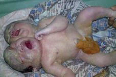 Bayi Kembar Dempet tanpa...