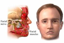 Apa itu Bells Palsy?