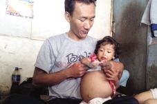 Bocah 1,5 Tahun Menderita...