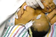 Bayi Kembar Siam Meninggal...