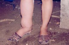 Penyakit Kaki Gajah...
