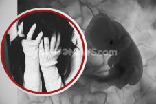 Kasus Aborsi di Surabaya,...