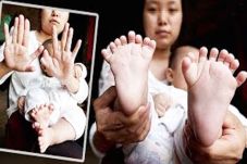 Had 31 Fingers and Toes,...