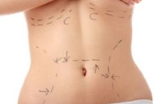 Bedah Plastik Liposuction...