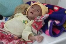 Derita Gizi Buruk, Bayi...