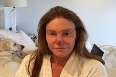 Hidung Kemerahan, Caitlyn...