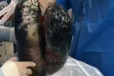 Viral, Paru-Paru Hitam...