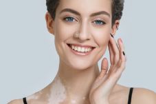 Penyakit Kulit Vitiligo...