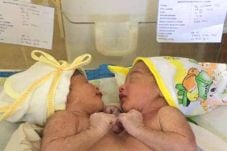 Bayi Kembar Dempet Dada...
