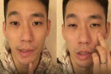 Mengenal Bells Palsy...