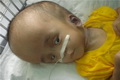 Bayi penderita hydrocephalus di Bogor butuh bantuan