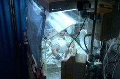 RSHS pertama kali tangani bayi kembar menempel di mulut