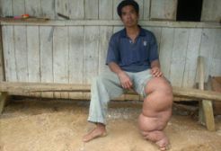 5 kecamatan di OKI endemis kaki gajah