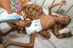 Kasus Gizi Buruk di Bangkalan Capai 138 Balita