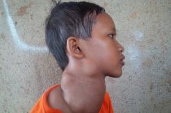 Penderita Tumor di Serang Berhenti Sekolah