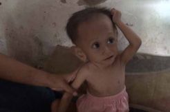 Anak Menderita Gizi Buruk, Wasis dan Sriati Pasrah