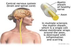 Wanita Rentan Terserang Multiple Sclerosis