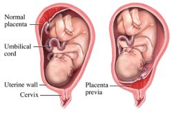 Plasenta Previa Ancam Keselamatan Ibu dan Bayi