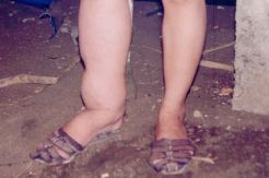 Penyakit Kaki Gajah Masih Menjadi Endemi di Indonesia