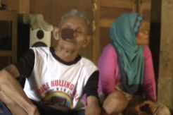 Diserang Tumor Ganas, Wajah Partorejo Rusak