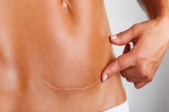 Ini Penyebab Munculnya Keloid di Kulit
