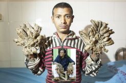 This Bazadar, Tree Man from Bangladesh