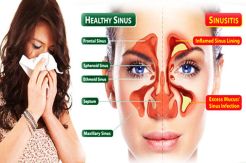 Mengenal Segala Hal yang Berkaitan dengan Sinusitis