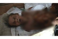Misinah Nenek 70 Tahun Penderita Lumpuh dan Punggung Berlubang