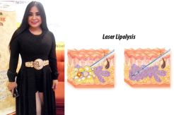Lipolysis Laser, Make Hard Fat Able to Melt