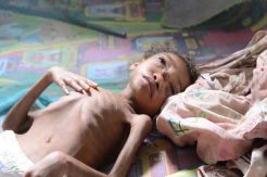 Bocah di Kabupaten Sorong Ini Terkena Gizi Buruk, Bupati Kemana?