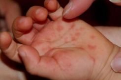 Flu Singapura Mewabah di Ponorogo, Belasan Balita Mulai Terserang