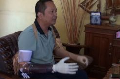 Serka Siswadi Bakal Dapat Tangan Bionic Baru