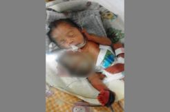 Operasi Tumor Bayi Melisa Belum Dilakukan, Ini Alasannya