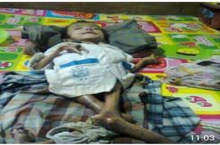 Alami Gizi Buruk, Remaja 15 Tahun Ini Beratnya Hanya 10 Kg