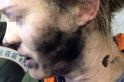 Wajah Wanita Ini Gosong Akibat Headphonenya Meledak