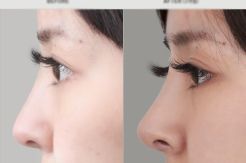 Bedah Plastik Hidung...