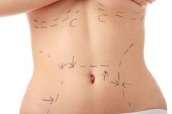 Bedah Plastik Liposuction...