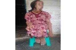 Tolong, Penderita Kanker Kulit Ini Butuh Uluran Dermawan