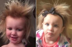 Penyakit Unik, Rambut Anak Ini Tak Bisa Disisir