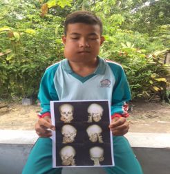 Remaja Miskin Penderita Tumor Tulang Rahang Ini Butuh Bantuan