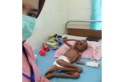Kondisi Bocah Penderita Gizi Buruk Akut Mulai Membaik