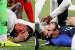 Enam Jahitan di Kepala, Giroud Diragukan Tampil di Laga Pembuka