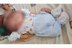 Tolong! Bayi Berwajah Dua Pengidap Hydrocephalus Ini Butuh Bantuan