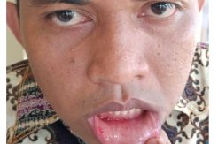 Dipukul Oknum Dewan, Bibir Anggota Satlantas Ini Pecah
