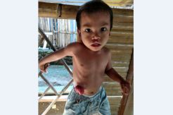 Butuh Bantuan Dermawan, 2,5 Tahun Bocah ini Hidup Tanpa Anus