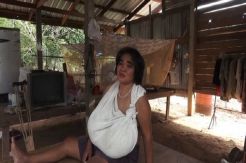 Payudara Terus Tumbuh Tak Terkendali, Wanita Ini Kesakitan