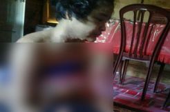 Prihatin! Gadis Madina Ini Menderita Penyakit Aneh