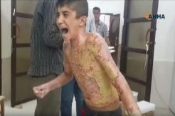 Anak-anak Kurdi Luka Bakar, Turki Dituduh Gunakan Senjata Kimia